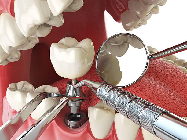 Best Emergency Wisdom Tooth Extraction in Columbus, NC